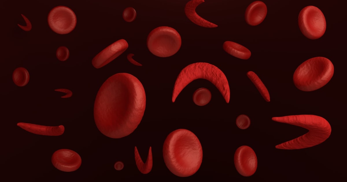 Stanford develops CRISPR-based therapy for sickle cell disease