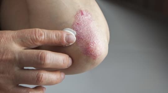 This cream on can soothe a psoriasis flare-up