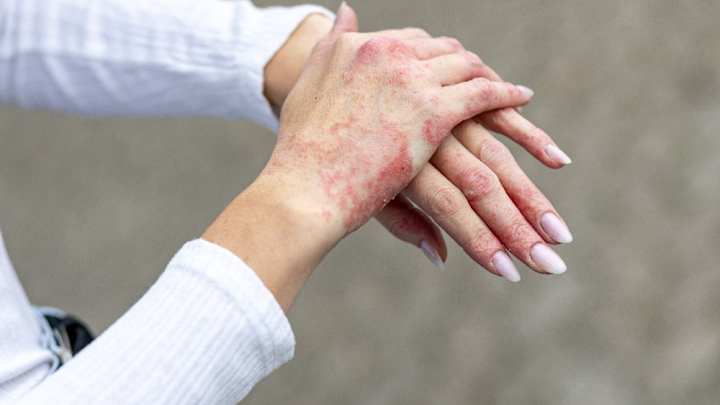 Do you know what causes eczema? The unexpected fuel behind flare-ups, and how to treat it