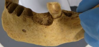 Ancient teeth rarely have a cavity-causing bacteria commonly seen today. A new study reveals why