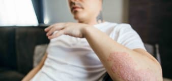 What is plaque psoriasis?