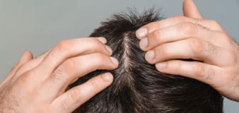 4 things to know about DHT blockers for hair loss