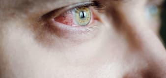 What is eye syphilis? The severe symptom doctors are seeing amid the STD epidemic