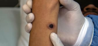 Mpox outbreak reported in Cleveland area after 11 cases reported: What is the disease?