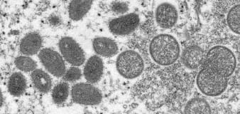 3rd possible case of monkeypox found in the U.S.